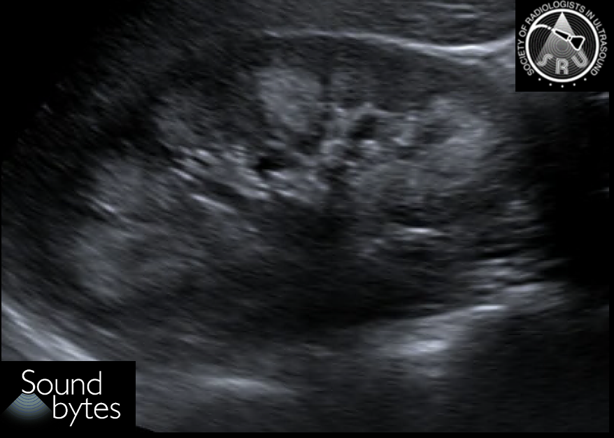 Answer to last week's case: Medullary nephrocalcinosis Longitudinal grayscale image through the right kidney demonstrates increased echogenicity of the renal pyramids diffusely. Case Courtesy of Dr. Preethi Raghu, UCSF #ultrasound #RadRes @preethiraghumd