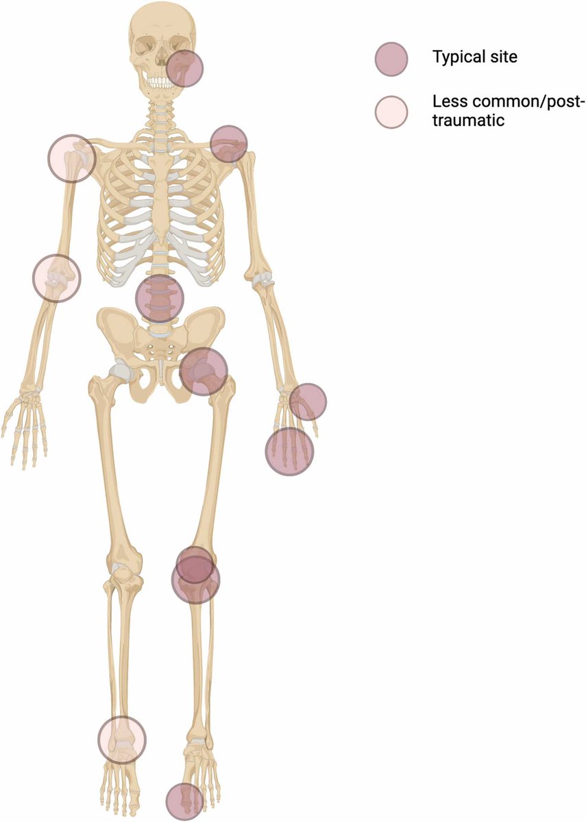 In this month's issue, read the review paper by Amanda E Nelson on multiple joint #osteoarthritis 🦴 The figure highlights common sites and less common/post-traumatic sites of OA 📖 Read more doi.org/10.1016/j.joca…