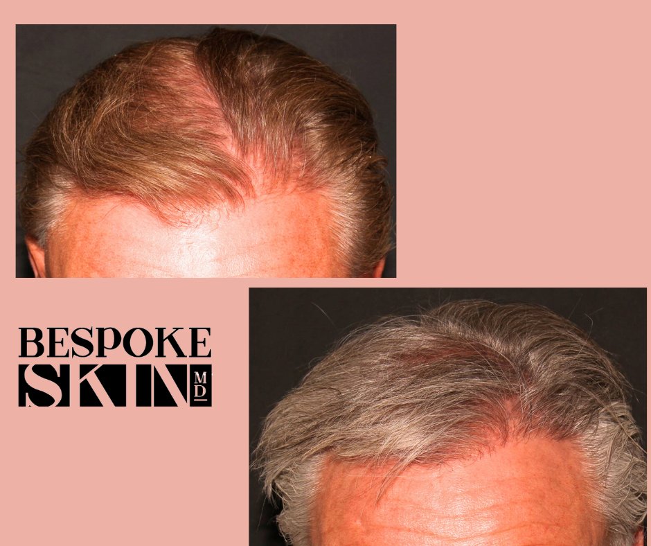 7 months post  FUE Hair Transplant #ygk #kingston #kingstonontario #plasticsurgeon #malepatternbaldness #hairestoration #hairsurgeon #FUE #smartgraft #malepatternhairloss #hairtransplant #Hairloss #hairline #hairlosstreatment #hairgoals #recedinghair #hairlove #hairlosshelp