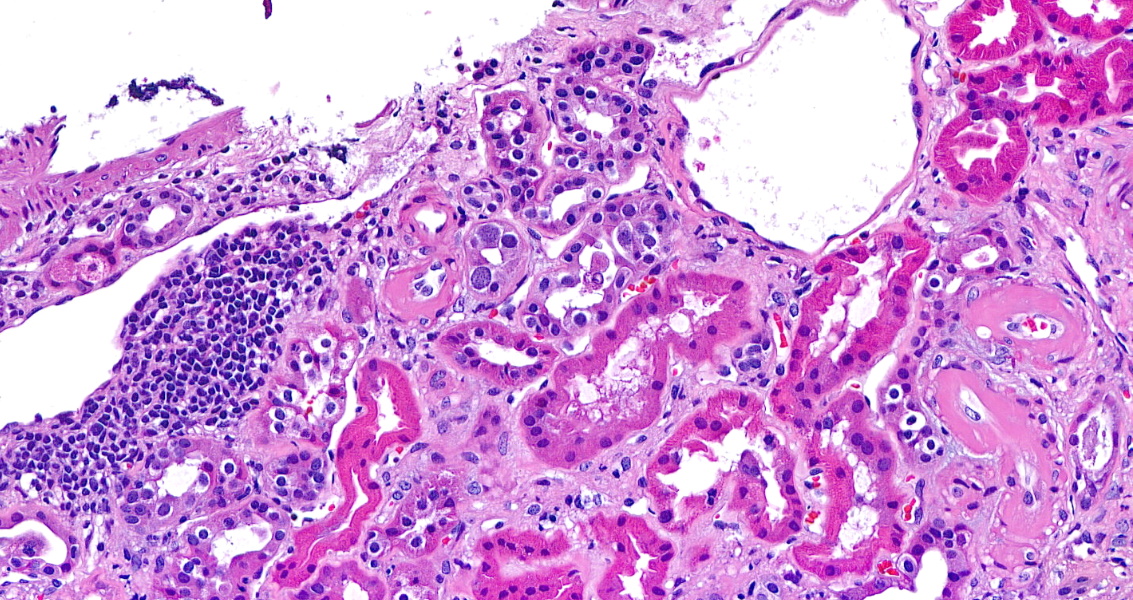 roboonya's tweet photo. Graft biopsy from 40s yo man s/p tx 6+ y shows tubular nuclei with intranuclear viral inclusions. SV40 positive. No BK viremia detected #JCvirus #renalpathology https://t.co/YuOtLZC7Of