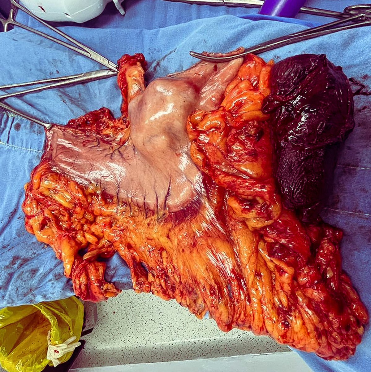 SAOlatam's tweet photo. Subtotal gastrectomy and splenectomy with D2 lymph node dissection due to a adenocarcinoma of the great curvature ⁦@rdgzgarciaonco⁩ ⁦@cuellarluis⁩ ⁦@Surgicalberserk⁩ #gastriccancer https://t.co/6e3YmV8E7z