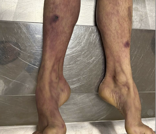 Investigan la muerte de un hombre de 36 años que estaba en manos de los Bizkor de la Ertzaintza

naiz.eus/es/info/notici…

NAIZ publica las imágenes, la autopsia y las iniciativas para esclarecerlo