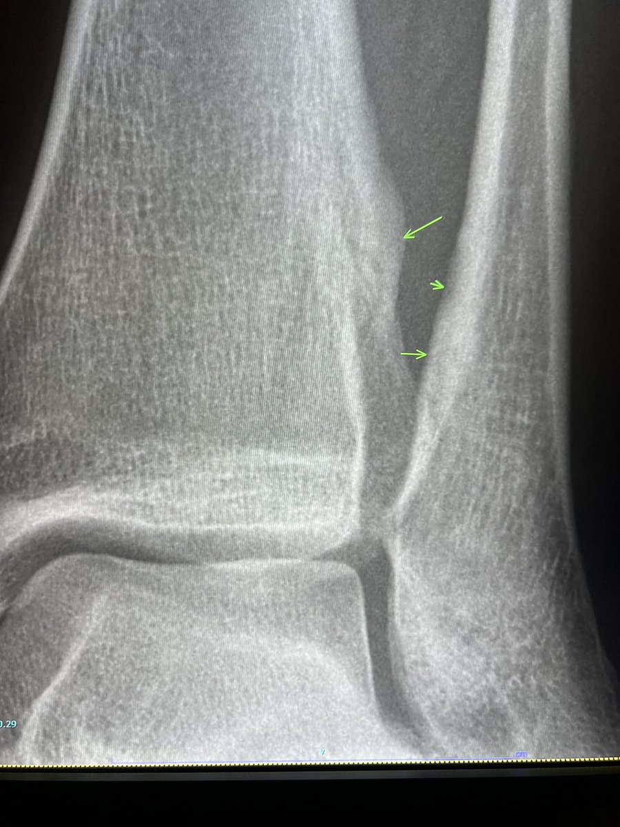 Distal Tib-Fib remodelling with neoosteogenesis and cortical thickening of the tibia/fibula—sequel of syndesmotic injury. Underreported on radiographs. —on-call cases