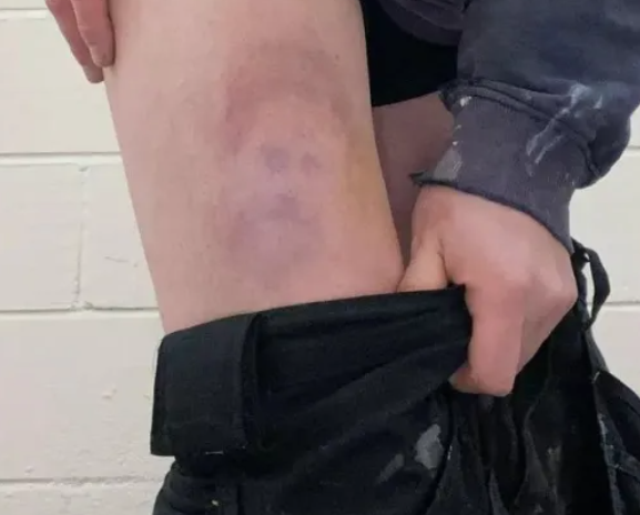 Man gets a bruise while playing football which looks exactly like......

Prince Harry #wtf #forth1 #ayeright <a href="/BoogsTweets/">Boogie 📻</a> <a href="/MartynEwart/">Marty 📻</a>