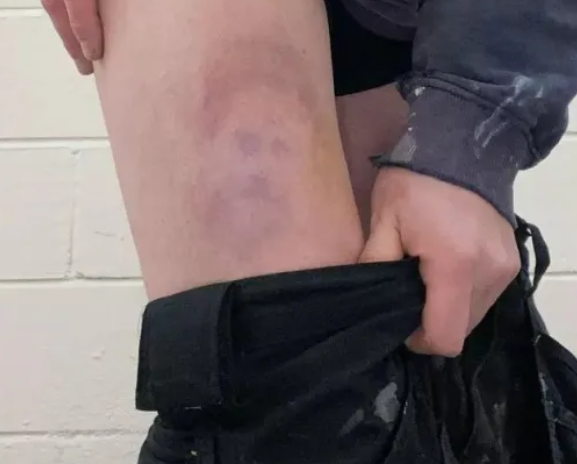 Man gets a bruise while playing football which looks exactly like...... Prince Harry #wtf #forth1 #ayeright @BoogsTweets @MartynEwart