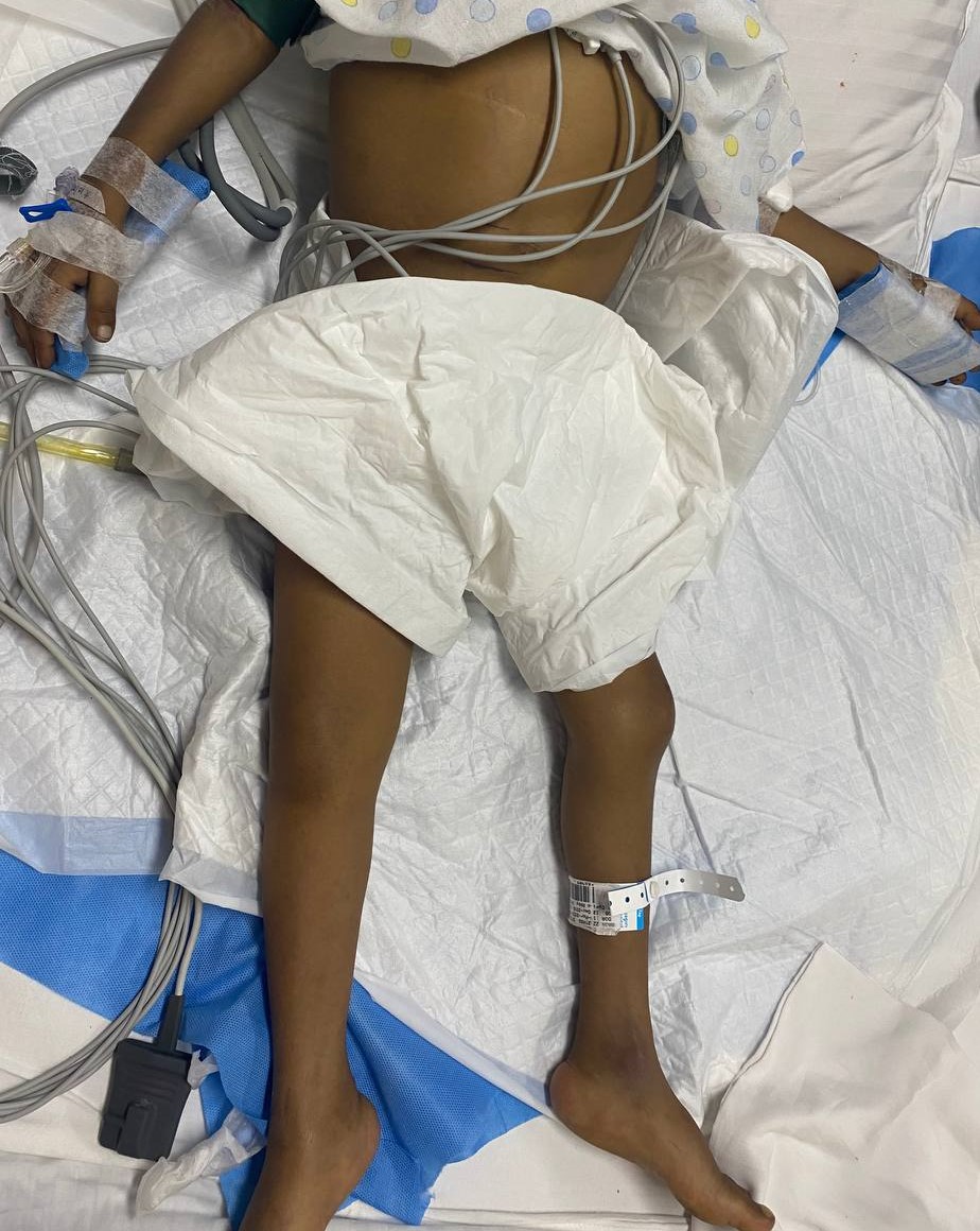 theliverdoc's tweet photo. Young boy with biliary atresia treated by Ayurveda practitioners for many months in 2022 and progressing rapidly to end stage liver disease, severe malnutrition ( due to Ayurvedic Viruddha Ahara nutrition concept) and brain failure inside our pediatric ICU.

Same boy, two years later, after we worked so hard to get him nutritionally fit, reverse organ failures other than liver failure and finally getting him a life saving liver transplantation (grandmother donated) and now learning karate!

In 2024, if you still do not realize that Ayurveda is a super scam when it comes to healthcare, you need a real education.