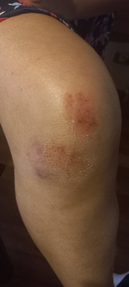 azulpipevale's tweet photo. @MuniNunoa @EmiliaRios  vaya a ver las veredas de jose domingo cañas y rafael prado todas rotas, muy peligroso caminar ahi, las caidas y torceduras de pie pasan a cada rato por adoquines sueltos . https://t.co/aCPVW3fyf8