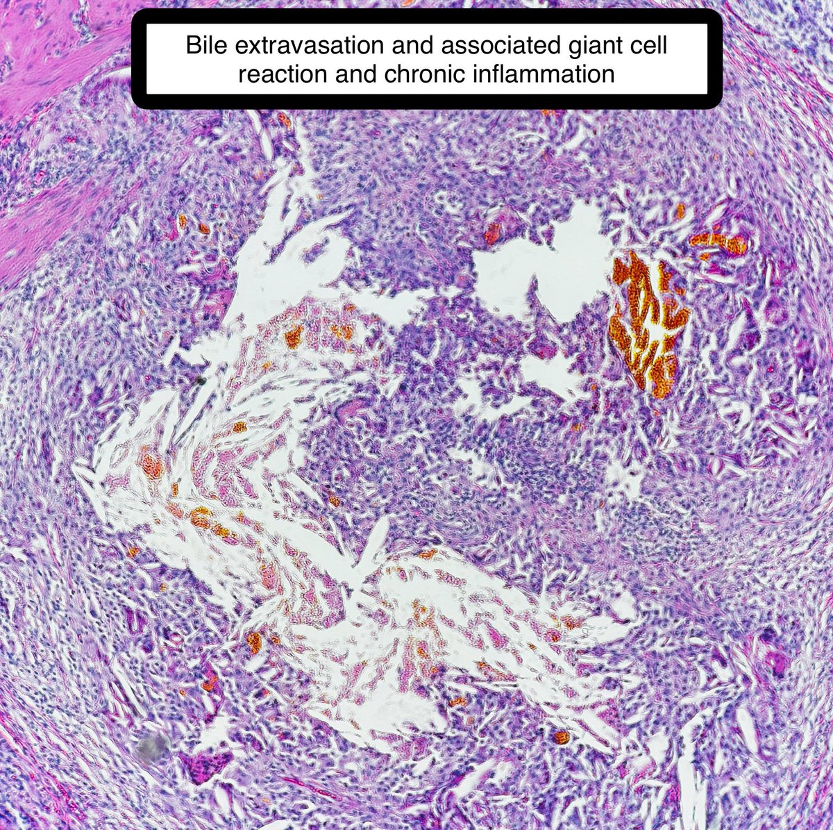 Cholecystitis. Simple, right?

Well, yes and no😅. There are some variants such as xanthogranulomatous cholecystitis

It may mimic gallbladder cancer

#pathagonia #pathx #gipath #gensurgx #generalsurgery #cholecystitis #lapchole #medstudentx #pathologyx #surgpath #medx #medicine