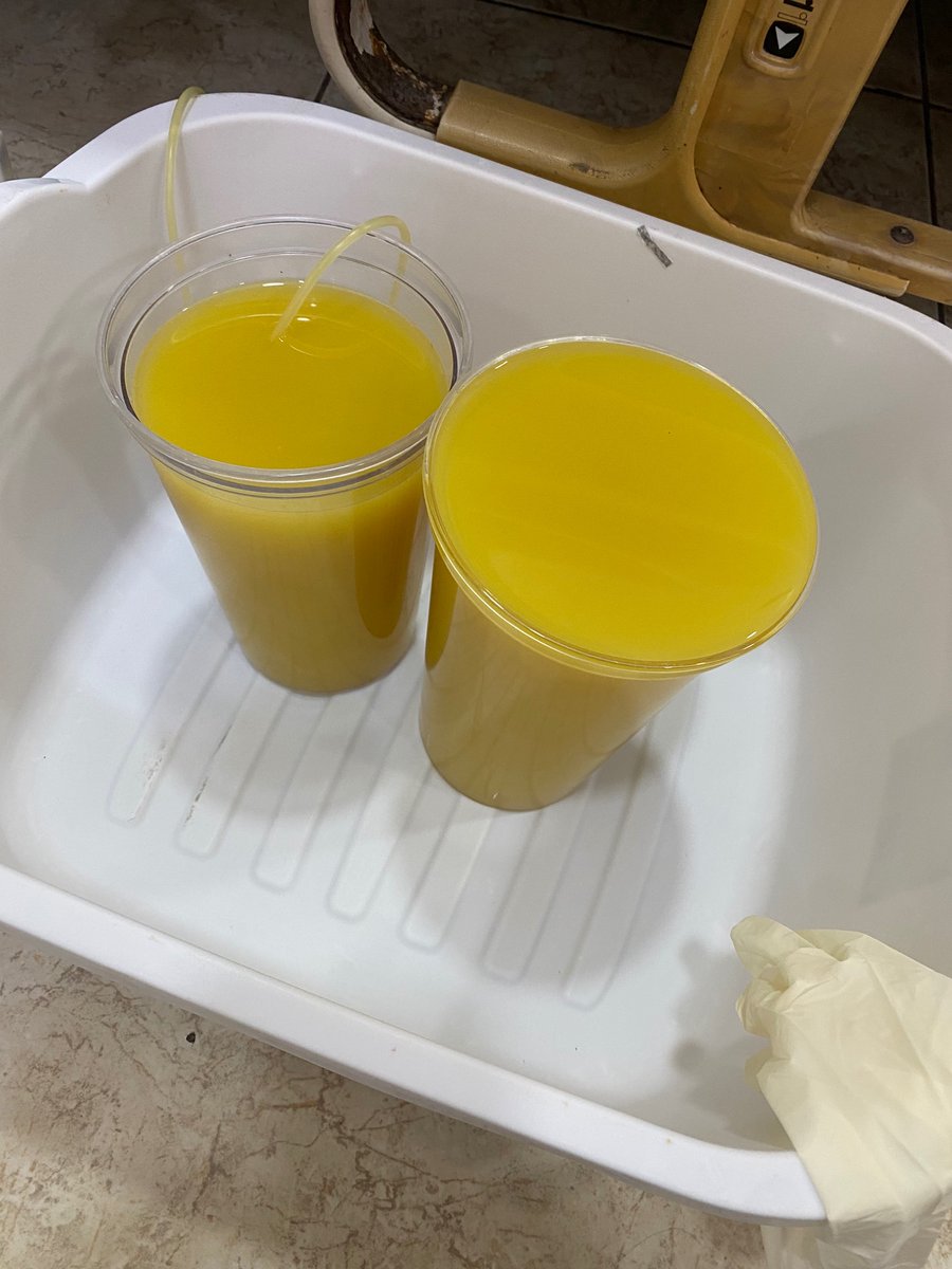 #medtwitter if I told you this was collected during a paracentesis what would you think?