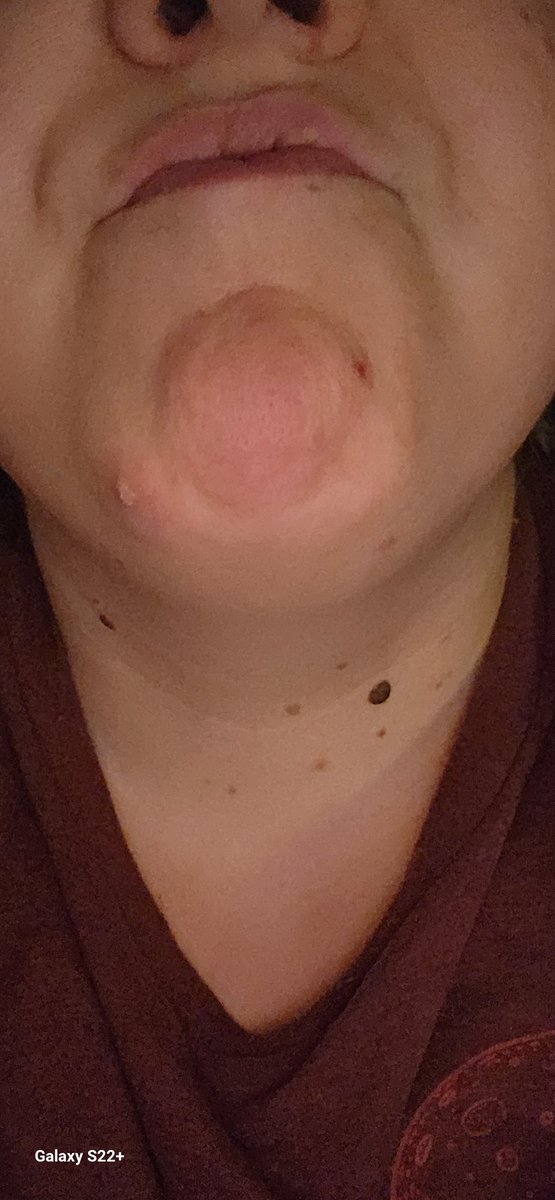 Indytruther1's tweet image. Things that suck about having pcos. It&apos;s when I get cystic acne towards my chin and neck area, my neck swells up, due to the inflammation and pain from the acne. #thejoysofwomanhood #pcosproblems