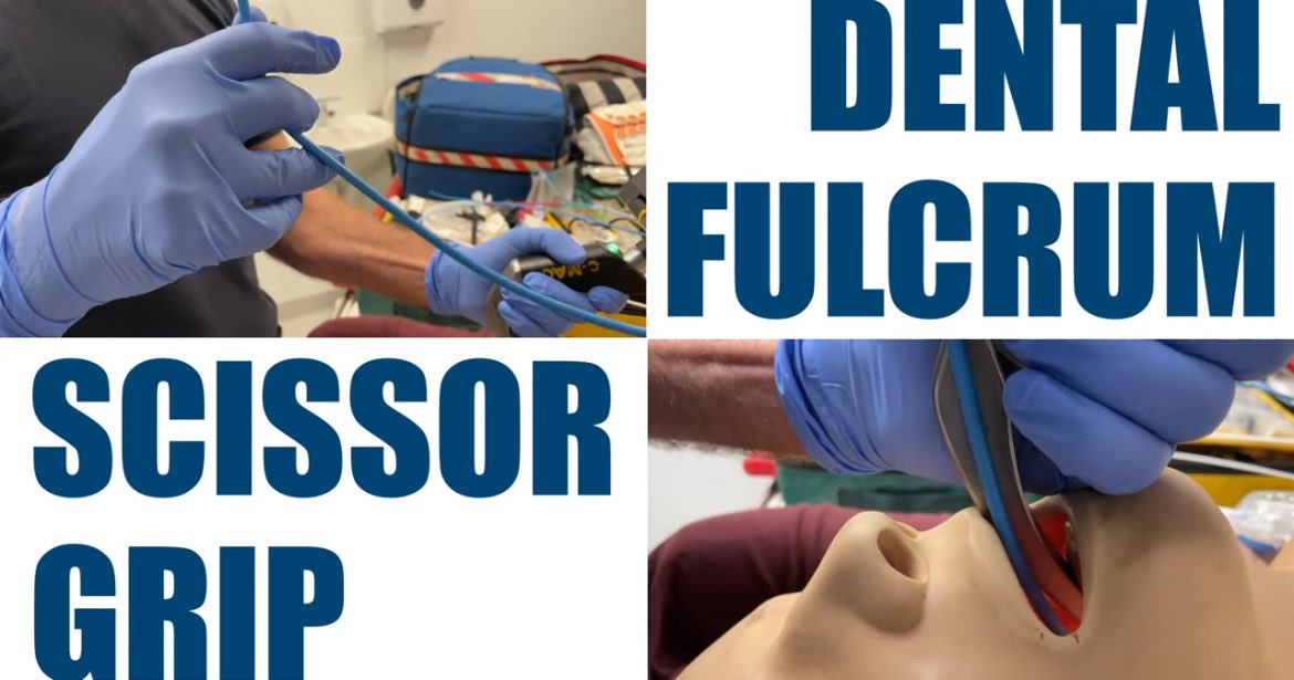 When using a bougie to facilitate intubation it’s important to know how to direct it Here’s a two minute video demonstrating two microskills that are worth knowing about Essential Bougie Microskills You Need To Know youtu.be/aMd8zeMnRSk