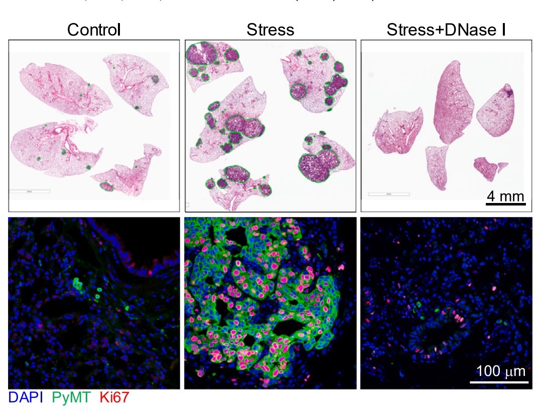 First mechanistic link between chronic stress and cancer. Chronic stress anticipates neutrophils diurnal peak in the blood of 5-8 hours. A factor to be considered in chronoimmunotherapy studies. Stress induced corticosteroids promote metastases growth by inducing NET. @megeblad