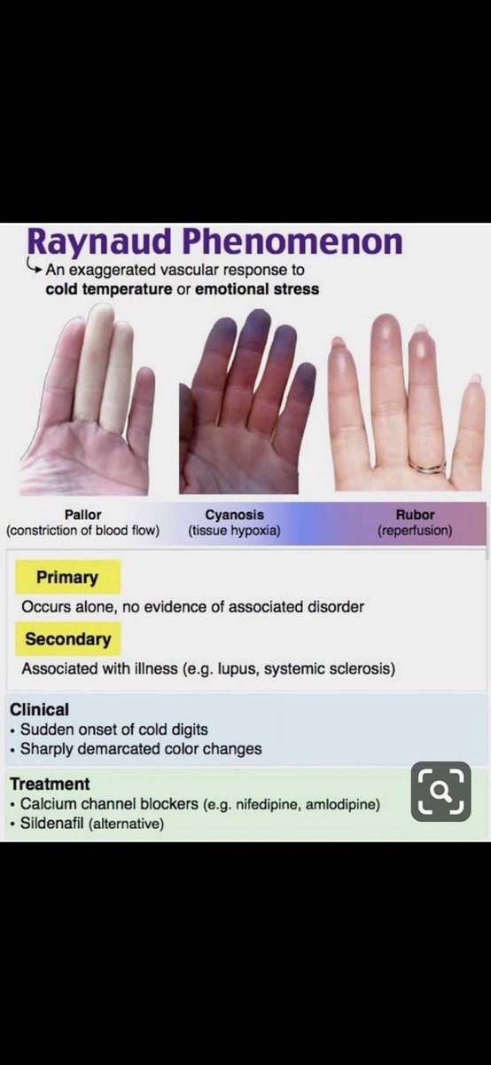 Raynaud Phenomenon ✋🏻 #FOAMed #FOAMcc #MedEd #medtwitter #MedicalStudents #emergencymedicine #medicalpractis #medicaleducation #resident