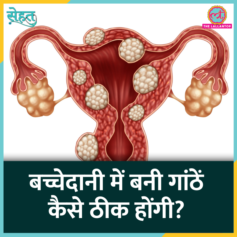 TheLallantop's tweet image. महिलाओं में कई बार गर्भाशय में गांठ बन जाती है. लेकिन ये कैंसर की गांठ नहीं. इन्हें कहते हैं #UterineFibroids. आज #Sehat में जानेंगे, यूटेरिन फाइब्रॉएड क्यों होता है, इसके लक्षण क्या हैं और इसका इलाज कैसे किया जाता है? 

👉 youtu.be/Y1Idue9X70A

@sarwat7fatima #Health #Cancer