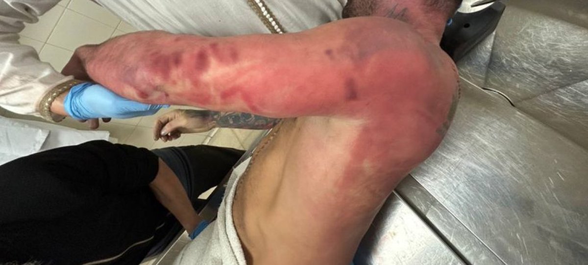 Ertzaintzaren esku-hartze bortitzean hil da pertsona bat Astigarragan

Agerraldi psikotiko bat izan zuen eta Ertzaintzak esku hartu zuen. Hamaika lesio erakusten ditu autopsiak: borra-kolpeak, erredurak, taser pistolen markak, hautsitako saihetsak...

🔗 gedar.eus/aktualitatea/e…