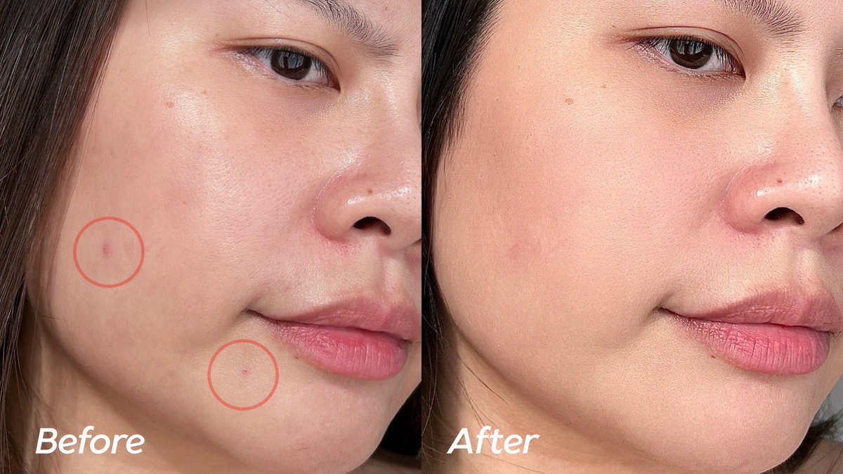 เรื่องผิวเนียนยกให้คลีนเซอร์ SA ของ Cerave จริงๆ มี Salicylic Acid ทั้งผลัดเซลล์ผิว ใช้ได้ตั้งเเต่หน้ายันตัวพวกลดสิวเสี้ยน คนเป็นสิวที่หลัง มีขุนคุด ควรจัด!! แถมยังมีเซราไมด์เสริมปราการผิวแข็งแรง หลังล้างผิวไม่แห้ง ไม่เอี๊ยดด้วย
พิกัดของแท้📍 bit.ly/3PrxxD0