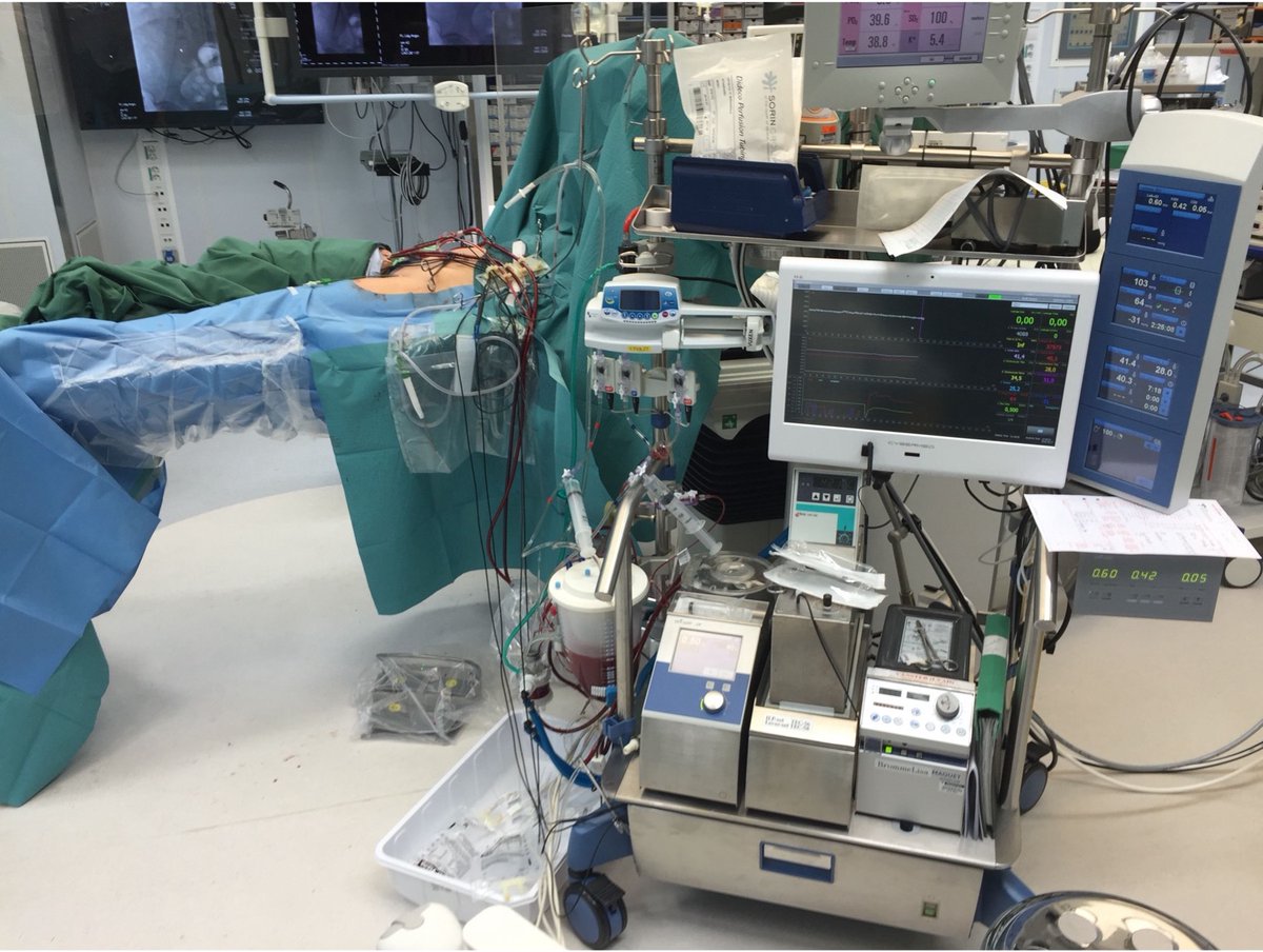 Roger Olofsson Bagge (@olofssonbagge) on Twitter photo How to perform isolated limb perfusion #ILP for advanced extremity malignancy: a consensus guideline authors.elsevier.com/c/1imvs2gGSo74… #sarcoma #melanoma <a href="/ejsotweets/">European Journal of Surgical Oncology</a> How to perform isolated limb perfusion #ILP for advanced extremity malignancy: a consensus guideline authors.elsevier.com/c/1imvs2gGSo74… #sarcoma #melanoma <a href="/ejsotweets/">European Journal of Surgical Oncology</a>
