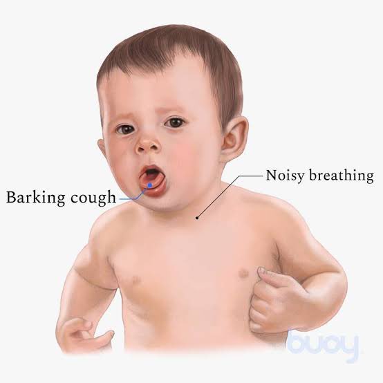 #Clinical_Case🦠

“A child with a barking cough and stridor at night, normal breathing during the day. 

What's the likely diagnosis?
A) Asthma
B) Bronchiolitis
C) Croup
D) Tuberculosis

#Pediatrics #Respiratory #MedicalTwitter'