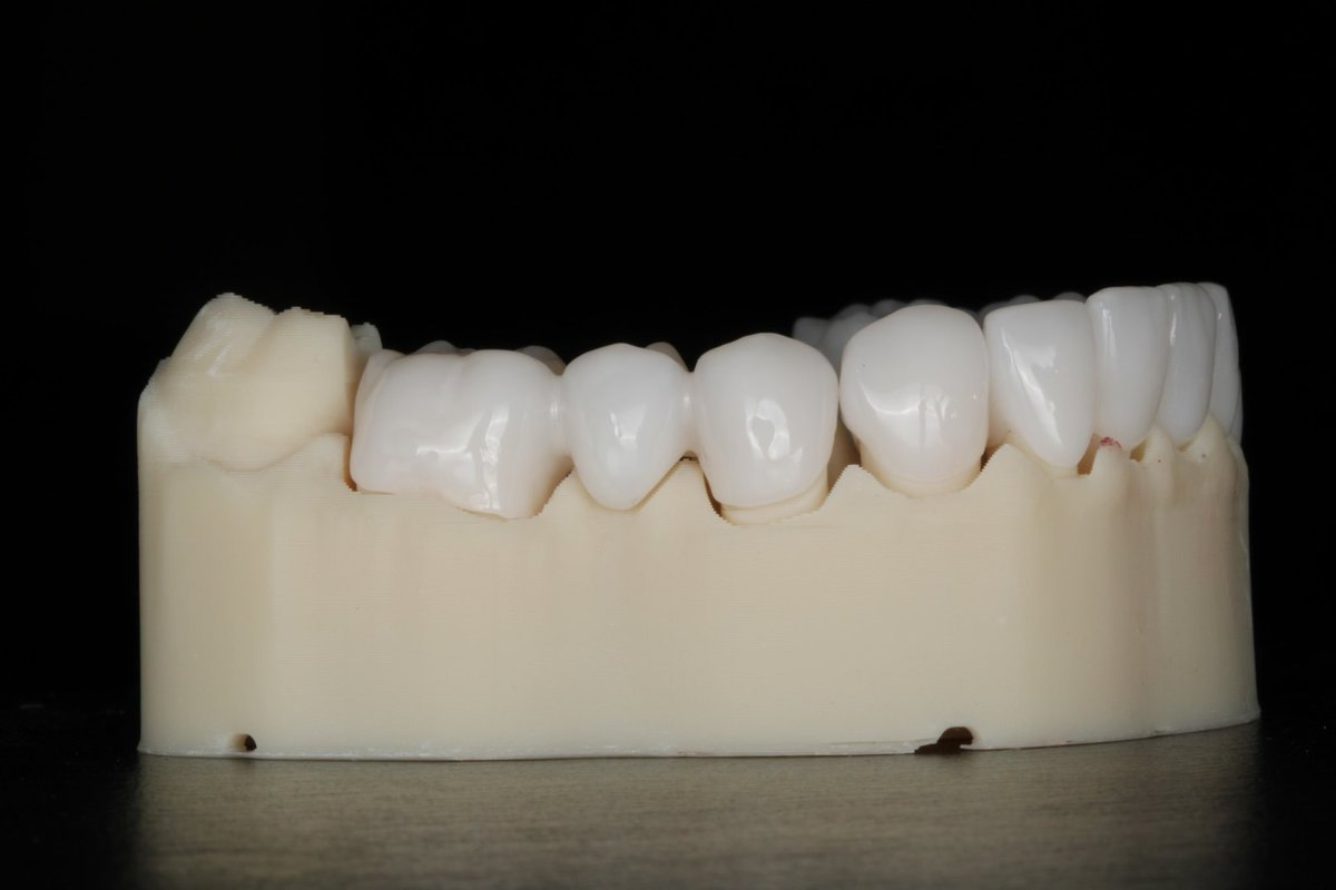 DrZSmiles's tweet photo. Crafting smiles with precision and passion! Our custom Zirconia bridges are more than just dental work; they’re masterpieces of aesthetic dentistry designed to blend seamlessly with your natural smile. Strong, durable, and beautifully translucent, Zirconia is the material of choice for a smile that lasts. Ready to bridge the gap to your perfect smile? Dr. Z Smiles is here to guide you every step of the way. 
.
.
.
.
.
#ZirconiaBridges #SmileWithConfidence #DentalMasterpiece #AestheticDentistry #DrZSmiles #LastingSmile #DentalPerfection #ToothBridge #DentalArt #qualitydentistry