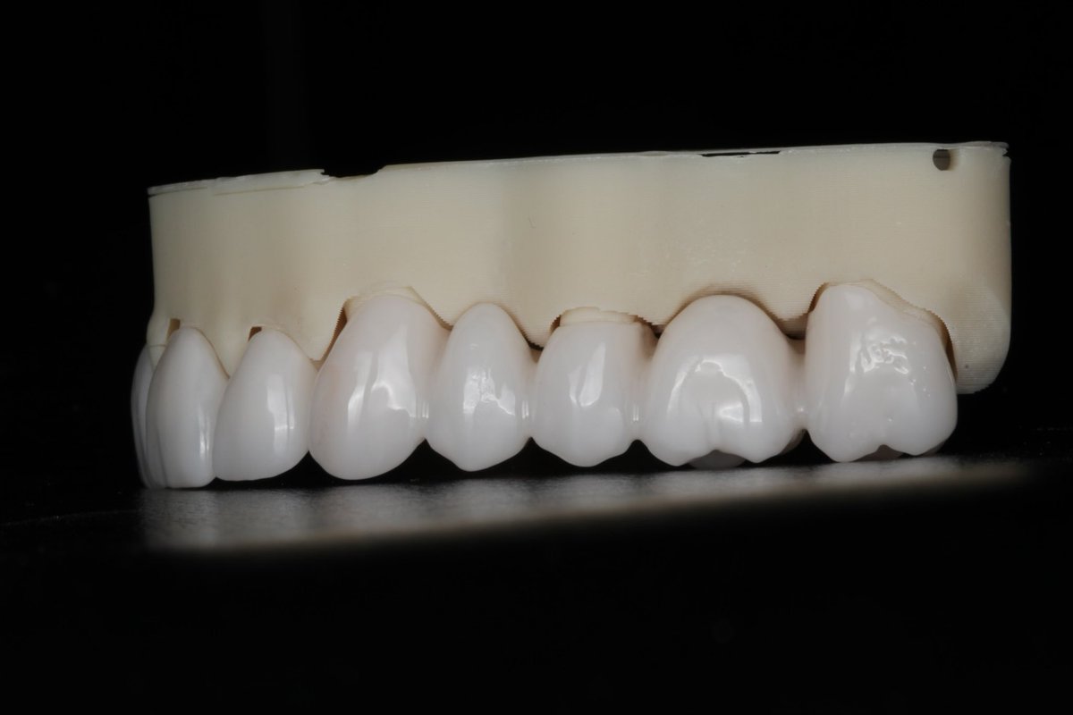 DrZSmiles's tweet photo. Crafting smiles with precision and passion! Our custom Zirconia bridges are more than just dental work; they’re masterpieces of aesthetic dentistry designed to blend seamlessly with your natural smile. Strong, durable, and beautifully translucent, Zirconia is the material of choice for a smile that lasts. Ready to bridge the gap to your perfect smile? Dr. Z Smiles is here to guide you every step of the way. 
.
.
.
.
.
#ZirconiaBridges #SmileWithConfidence #DentalMasterpiece #AestheticDentistry #DrZSmiles #LastingSmile #DentalPerfection #ToothBridge #DentalArt #qualitydentistry