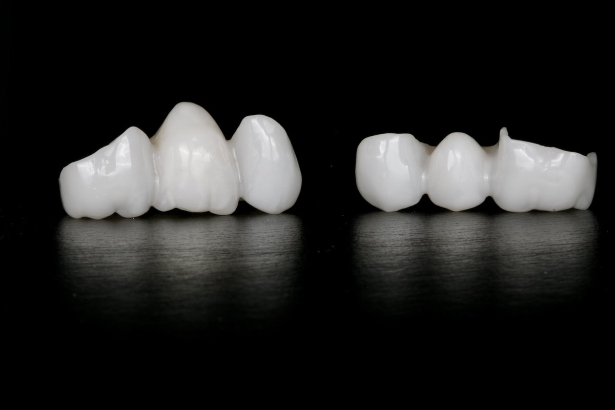 DrZSmiles's tweet photo. Crafting smiles with precision and passion! Our custom Zirconia bridges are more than just dental work; they’re masterpieces of aesthetic dentistry designed to blend seamlessly with your natural smile. Strong, durable, and beautifully translucent, Zirconia is the material of choice for a smile that lasts. Ready to bridge the gap to your perfect smile? Dr. Z Smiles is here to guide you every step of the way. 
.
.
.
.
.
#ZirconiaBridges #SmileWithConfidence #DentalMasterpiece #AestheticDentistry #DrZSmiles #LastingSmile #DentalPerfection #ToothBridge #DentalArt #qualitydentistry