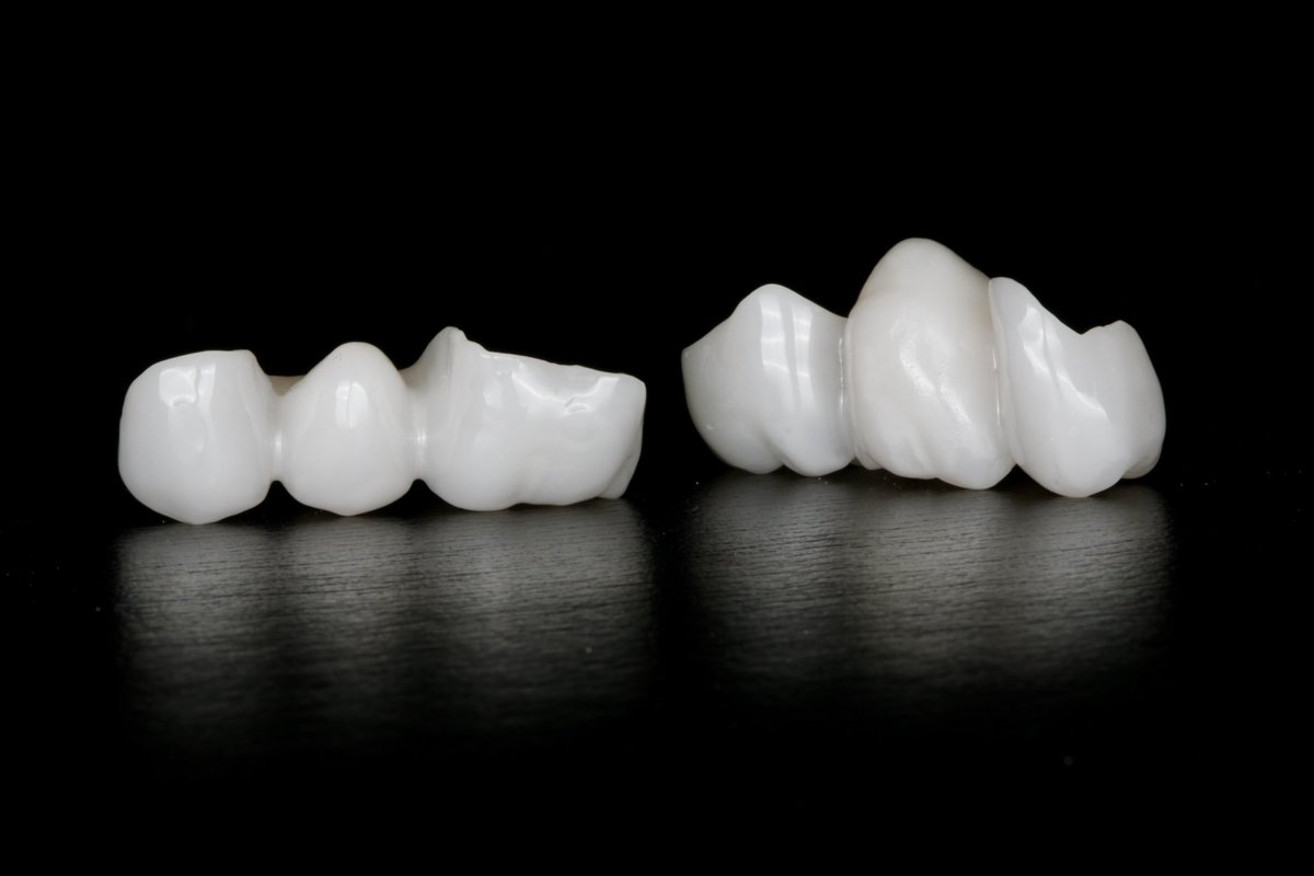 DrZSmiles's tweet photo. Crafting smiles with precision and passion! Our custom Zirconia bridges are more than just dental work; they’re masterpieces of aesthetic dentistry designed to blend seamlessly with your natural smile. Strong, durable, and beautifully translucent, Zirconia is the material of choice for a smile that lasts. Ready to bridge the gap to your perfect smile? Dr. Z Smiles is here to guide you every step of the way. 
.
.
.
.
.
#ZirconiaBridges #SmileWithConfidence #DentalMasterpiece #AestheticDentistry #DrZSmiles #LastingSmile #DentalPerfection #ToothBridge #DentalArt #qualitydentistry