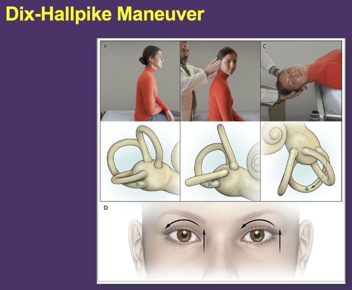 Benign Paroxysmal Positional Vertigo - displacement of NL calcium crystals (otoliths) w/ abNL stimulation of vestibular system; s/s: vertigo (spinning sensation) triggered by specific changes in  head position, positional nystagmus; Dx: Dix-Hallpike; Rx: Epley or Semont maneuver