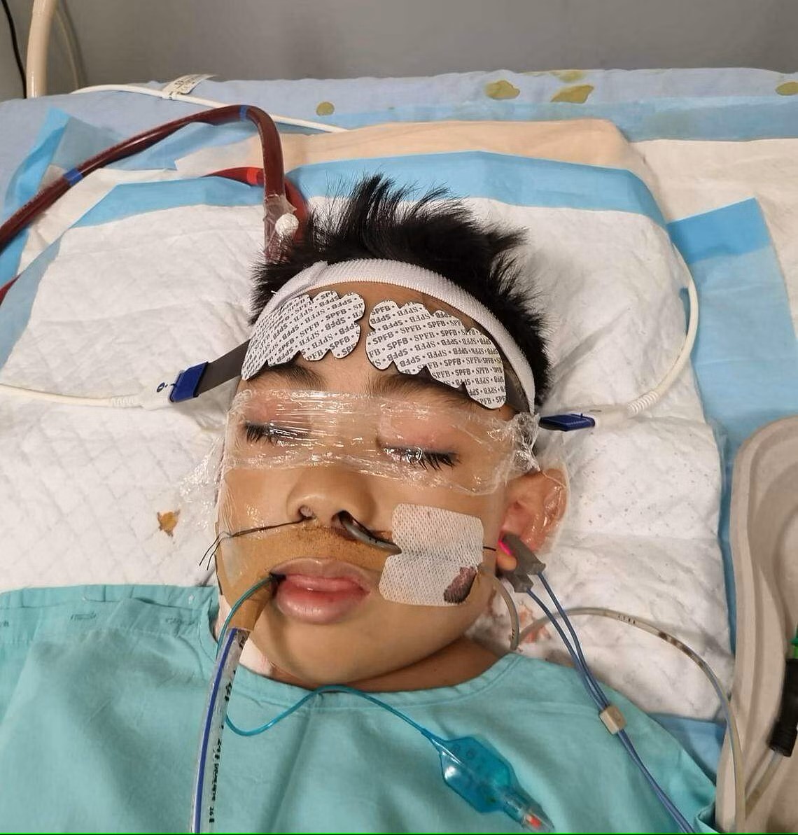 A nine year old boy named Matt in Singapore was infected with COVID in January 2024. Unfortunately he developed myocarditis (inflammation of the heart muscle) from the COVID infection and then had a stroke which weakened his left side ( straitstimes.com/life/triple-wh… ). 🧵1/