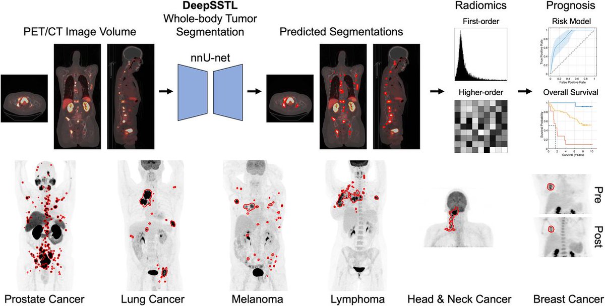 A new deep, semisupervised transfer learning approach for fully automated, whole-body tumor segmentation and prognosis on PET/CT: ow.ly/LnoK50QMStr #NuclearMedicine #DeepLearning #PETscan @radnump