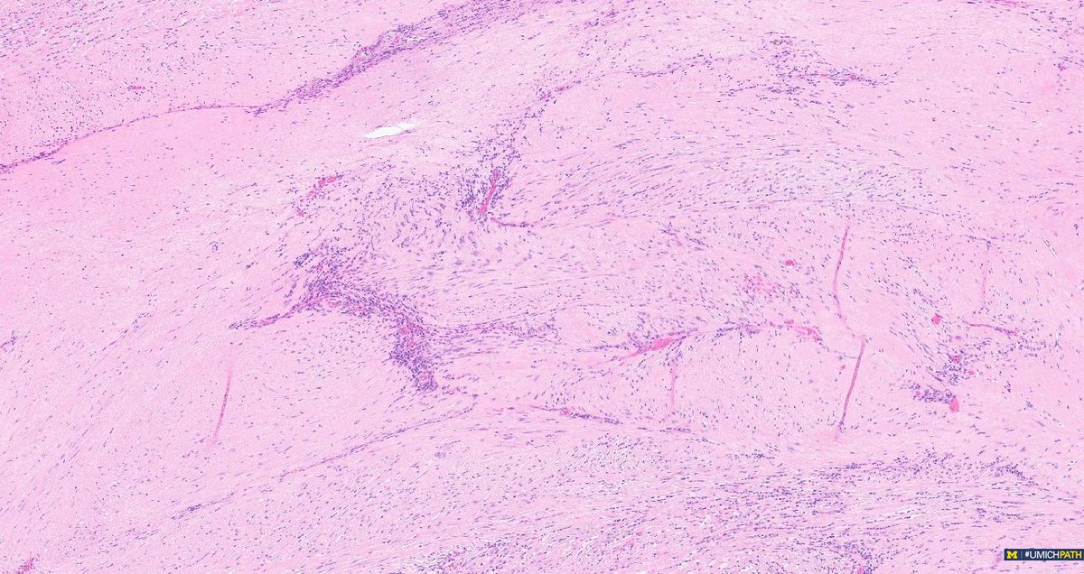 Michigan Pathology (@umichpath) on Twitter photo 🔬Check out this #COTW from <a href="/sarahnfarran/">Sarah Farran, MD, MPH</a>!
A 52 yo F has a 12 cm polypoid exophytic mass arising from the myometrium. What is your diagnosis, and which stain can help confirm it? 🔬Check out this #COTW from <a href="/sarahnfarran/">Sarah Farran, MD, MPH</a>!
A 52 yo F has a 12 cm polypoid exophytic mass arising from the myometrium. What is your diagnosis, and which stain can help confirm it?