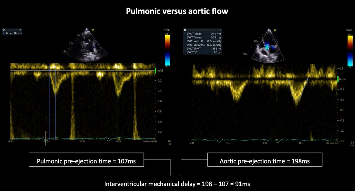 1/ I wonder what #Epeeps would do for a 62yo male patient with NICMP, LBBB QRSd >200ms, LVIDd 71mm, LVEF12%? Conventional CRT, LBB-CRT, LOT-CRT, too advanced for CRT? For CRT, any vendor preferences? @finnakerstrom @James_Elliott01 @enes_elvin @riley_guntrip @chris_monkhouse