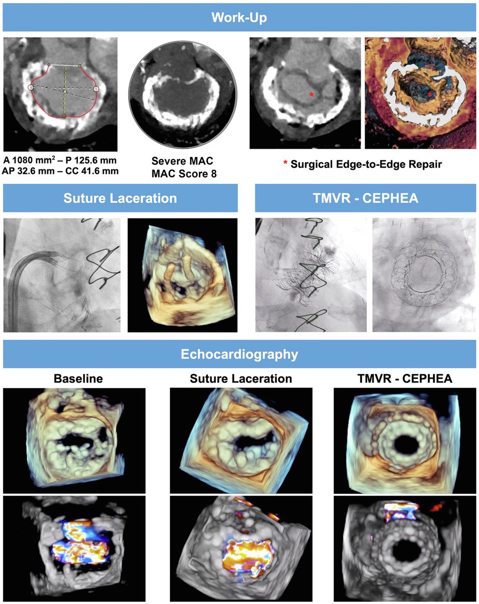 Percutaneous #TMVR with the Cephea valve system in - prior surgical edge-to-edge repair - severe MAC electrosurgery and dedicated devices might be beneficial to treat complex anatomies bit.ly/3TmEVRb #JACCINT #TEER @AndreaScotti21 @azeemlatib