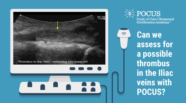 Every clinician should be able to learn to effectively diagnose a case of DVT using #POCUS. With up to 900,000 individuals affected by this condition in the US alone the potential benefits are enormous. Find out more in this week’s post 👉 bit.ly/43bIE8s