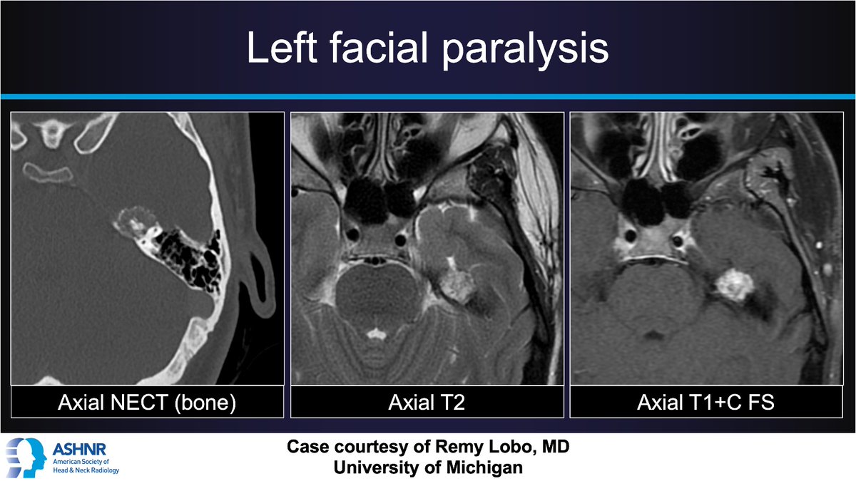 #ASHNRCOTW #245: L Facial Paralysis. Thx @remyrlobo 4 case! #ASHNR24 Answer w/ appropriate GIF only -- stay professional & don't spoil it! @callyrobs @DShatzkes @CDP_Rad @nakoontz @rhwiggins @KRileyMD @CMGlastonbury @cmtomblinson @tabby_kennedy @PhilipRChapman1 @AshokSrini15