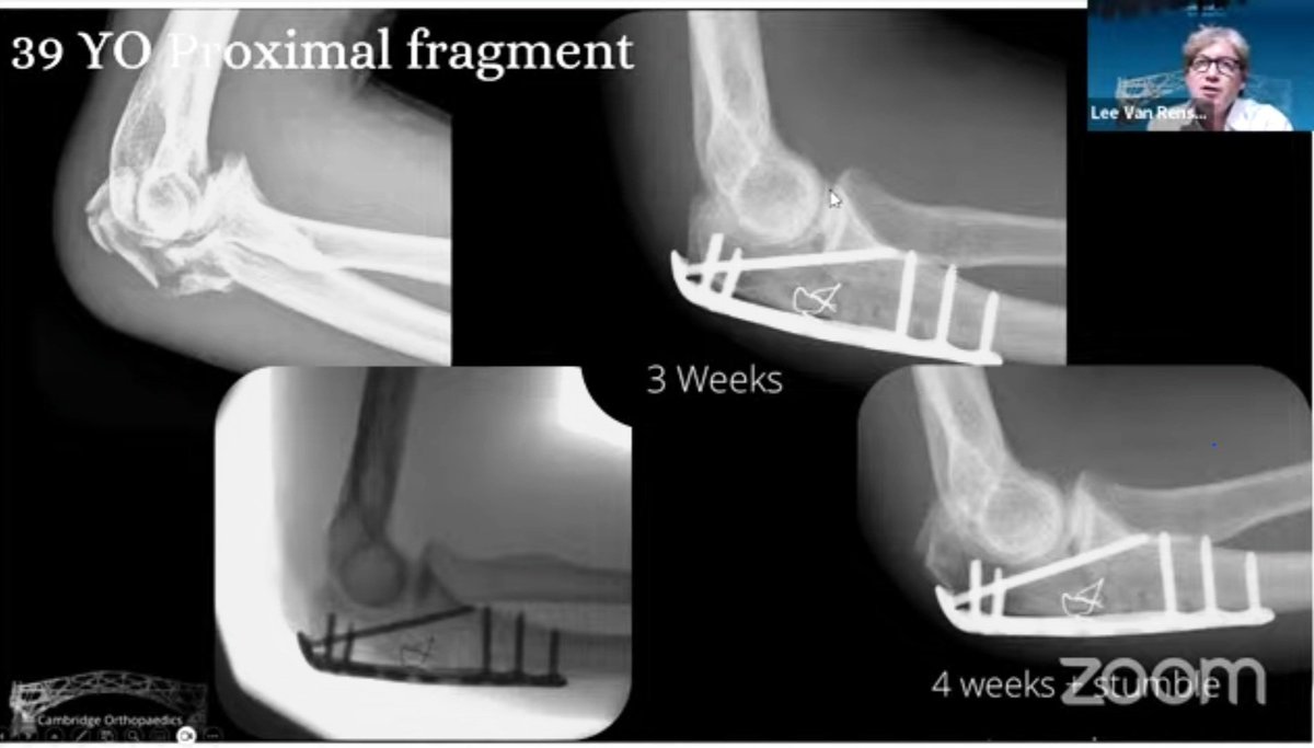 Prof (Dr) Hitesh Gopalan (@drhiteshg) on Twitter photo youtube.com/live/xvE1R9IR6…
Proximal Ulnar Fractures #orthopaedicprinciples <a href="/12crc/">CR Chandrasekar</a> <a href="/Drlyndonmason/">Lyndon Mason</a> <a href="/TSEOrthopaedics/">Thames Shoulder & Elbow</a> <a href="/JitMangwani/">Jit Mangwani</a> <a href="/DrNiravPandya/">Dr. Nirav Pandya, M.D.</a> <a href="/DrNickColyvas/">Nicholas Colyvas MD</a> youtube.com/live/xvE1R9IR6…
Proximal Ulnar Fractures #orthopaedicprinciples <a href="/12crc/">CR Chandrasekar</a> <a href="/Drlyndonmason/">Lyndon Mason</a> <a href="/TSEOrthopaedics/">Thames Shoulder & Elbow</a> <a href="/JitMangwani/">Jit Mangwani</a> <a href="/DrNiravPandya/">Dr. Nirav Pandya, M.D.</a> <a href="/DrNickColyvas/">Nicholas Colyvas MD</a>