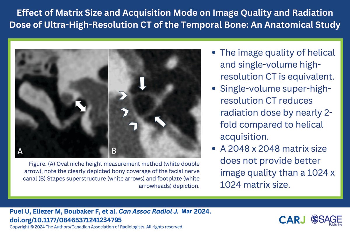 This recently published study assessed the effect of matrix size and acquisition mode on image quality and radiation dose of ultra-high-resolution CT of the temporal bone: doi.org/10.1177/084653… @CARadiologists @SageJournals #radiology #radres