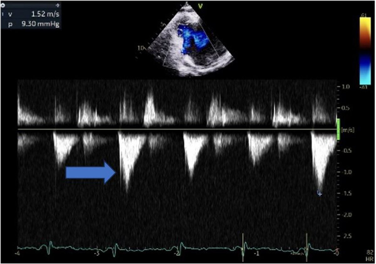 Endomyocardial fibrosis is a rare cardiac disease known to cause restrictive cardiomyopathy. The exact cause of EMF is unknown and it may mimic other cardiac diseases such as Ebstein anomaly and arrhythmogenic cardiomyopathy. Read our @CASEfromASE report: bit.ly/3Tu37Rw