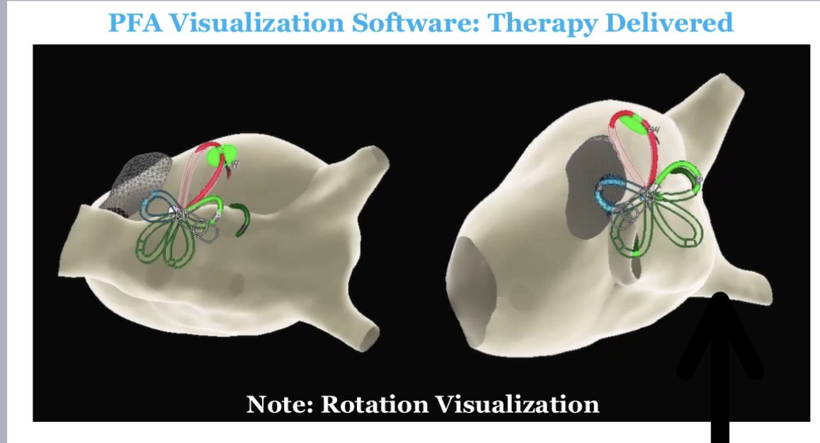 First PFA visualization using Ensite X new software.