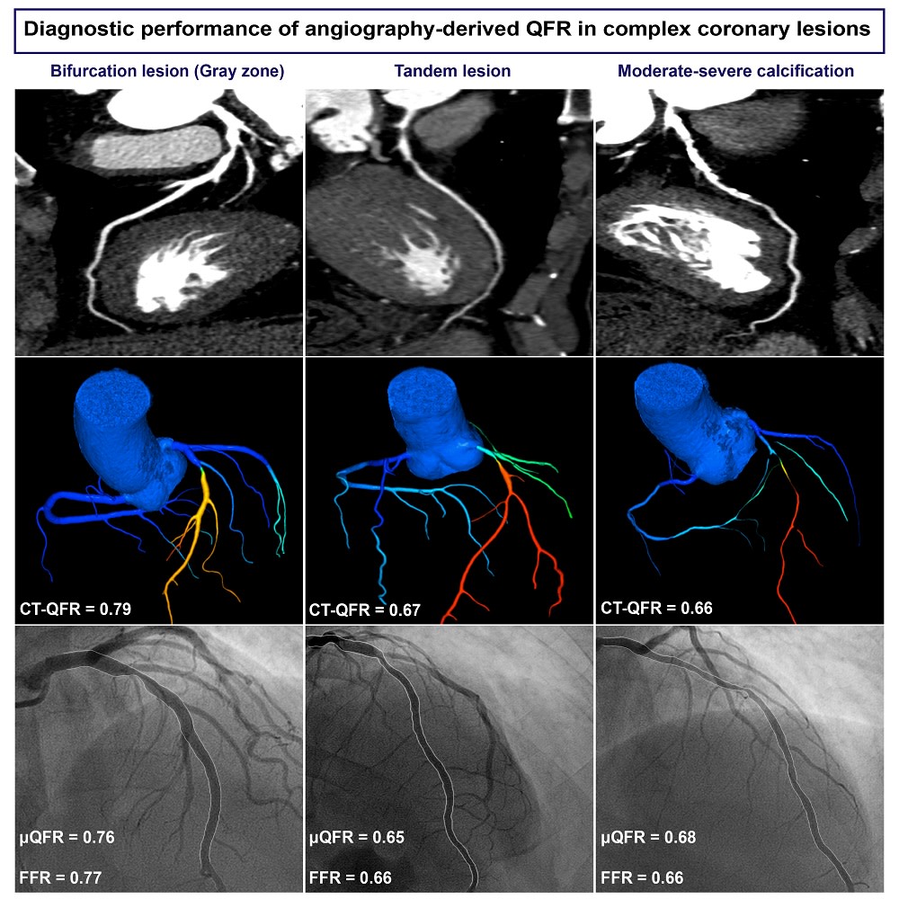 Diagnostic performance of angiography-derived quantitative flow ratio in complex coronary lesions #AHAJournals @JiwonKimMD @kaznegishi ahajrnls.org/3TujNbA