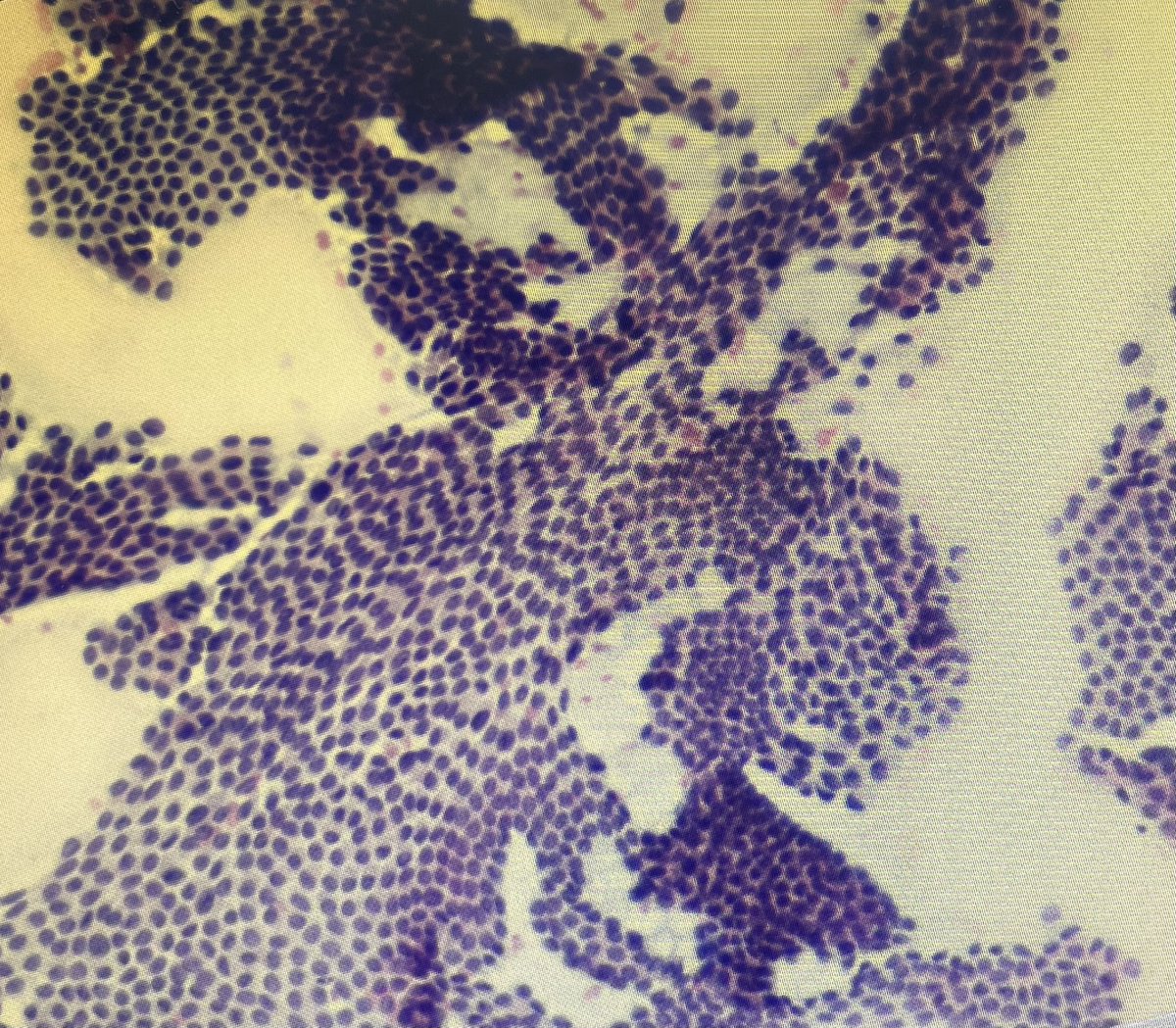 falarafa's tweet photo. Papillary thyroid carcinoma (PTC) as aggressive as The Great Wave off Kanagawa - Hokusai #PathArt #cytopathology #thyroidfna #pathology https://t.co/9YTu5Ssgk7