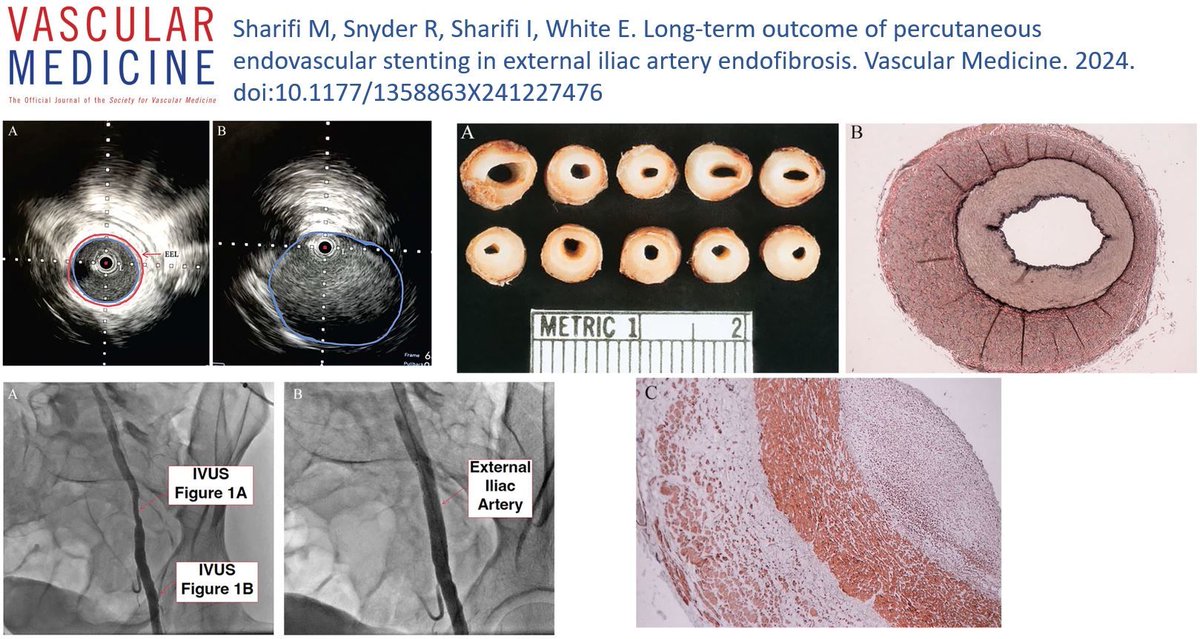 Online First! Sharifi et al. share long-term outcomes of percutaneous endovascular stenting in external iliac artery endofibrosis. buff.ly/4csPHOj