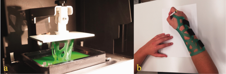 3D printing technology can be utilized to print splints for hand therapy following distal radius fractures. ❓Are they a safe alternative to conventional fibreglass casts? 🧑‍🤝‍🧑Will patients be satisfied? Let's delve into it 🧵 #Handtherapy #Handsurgery