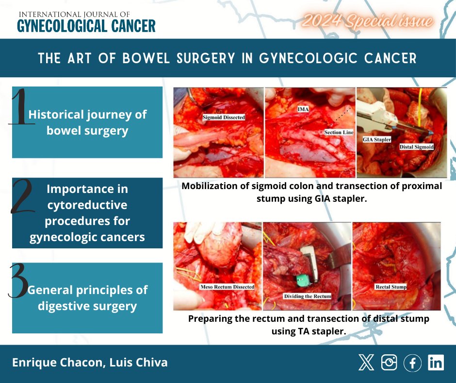 #2024SpecialIssue The art of bowel surgery in #gynecologiccancer @Quique_ChC @lchiv4 👉 bit.ly/49SsyDn @pedroramirezMD @HsuMd @JayrajAarthi @AndreFernandes2 @IGCSociety @ESGO_society @ENYGO_official @OncoAlert @IJGCfellows @GynMe4