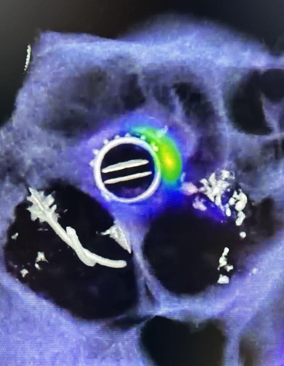 Typically acquire a separate triphasic multiphase CTA and then fuse to the FDG images using Syngo.via Oncology MM module for colocalization. It was easier when had Visage. Here’s an example of a case of aortic root abscess in a patient with mechanical aortic valve I did at BWH: