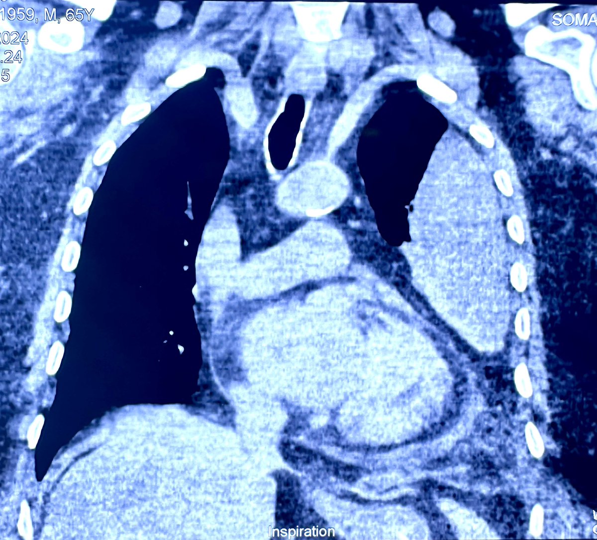 57y M, 3rd Post CABG day. Chest tubes removed. X-ray and CT Scan shows this. Pt stable. What could it be …..