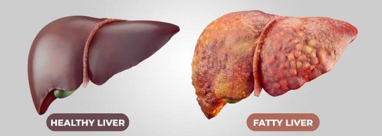 #RamadanFasting & #LiverDiseases: Few #Practical Tips

Writes DR. WAHID AKBAR

risingkashmir.com/ramadan-fastin…