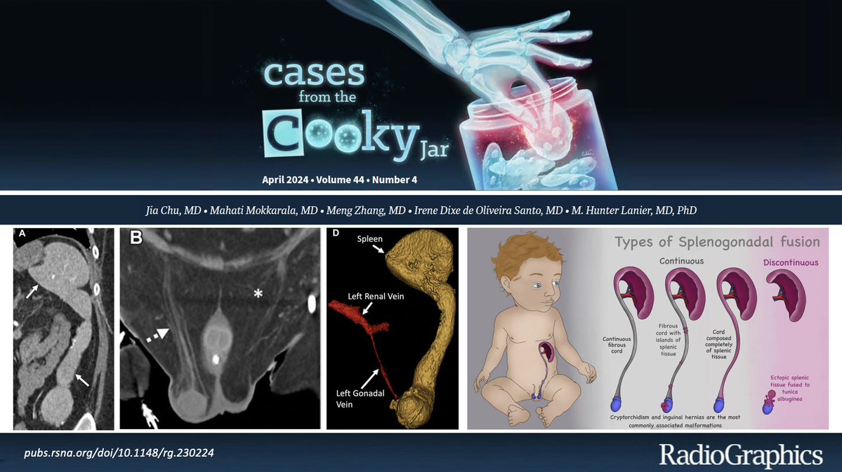 30-year-old man with congenital heart disease. Diagnosis❓ Answer: 🔗pubs.rsna.org/doi/10.1148/rg… Have a companion case? Share using #CookyBites #155 and we will RT the best cases! @cookyscan1 @RadioGraphics #RGphx