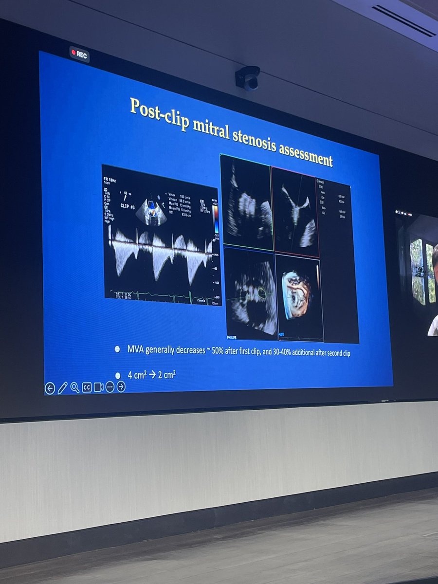 Thank you @FedericoAsch for giving @HeartPlano an excellent talk on MR quantification post Mitral TEER. It’s difficult to quantify MR post clip, but an integrative approach using qualitative,semiquantitative, and quantitative methods is best @ZuyueWangMD @AmroAlsaid @p_grayburn