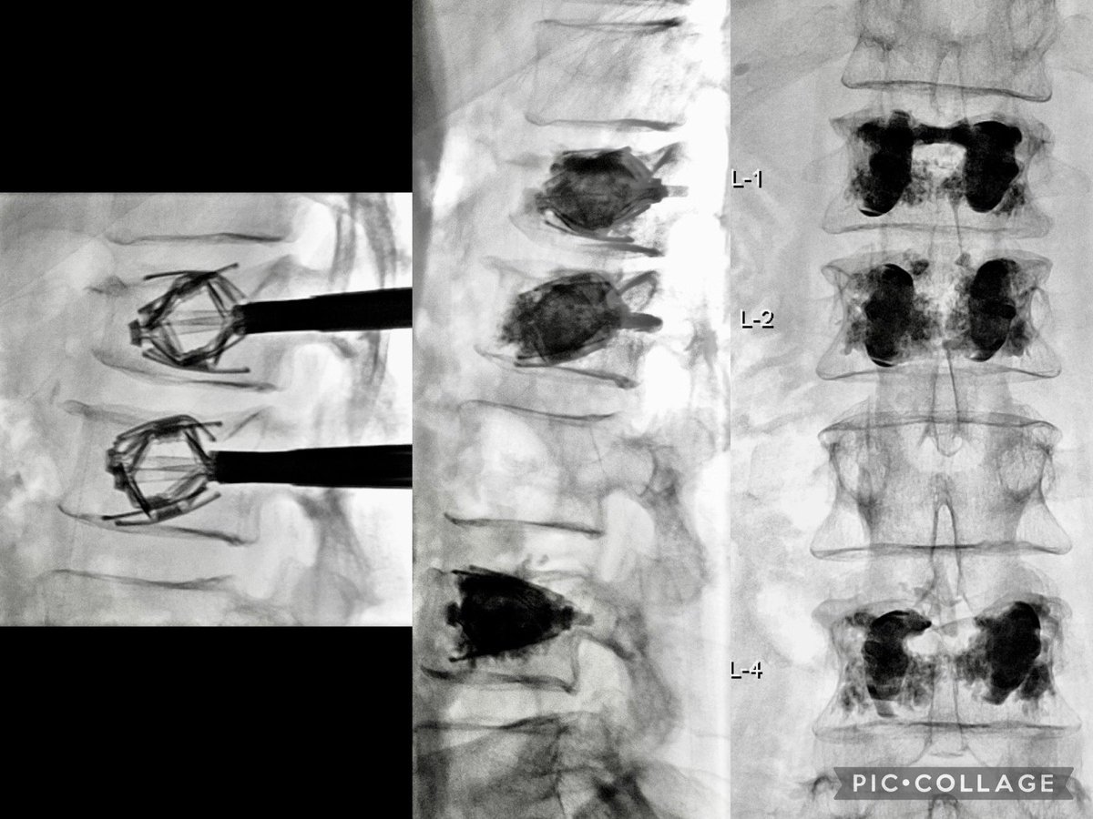 3 level lumbar SpineJack in severe osteoporotic fractures. L1 nearly pancaked, retropulsed. Patient pain 9➡️3 in 4 hours. ⬆️QOL. Standing up without pain after so long. #VertebralAugmentation #Happiness #AllJackedUp Huge thank you to @sav_squatch for amazing support…