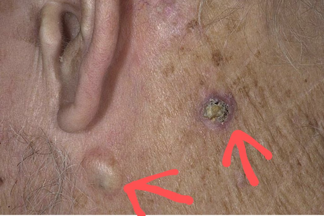 What are these two lesions? Diagnosis? Are they dangerous?

#MedTwitter #MedEd #MedX #MedKnowledge #medicine #dermatology 
@IhabFathiSulima